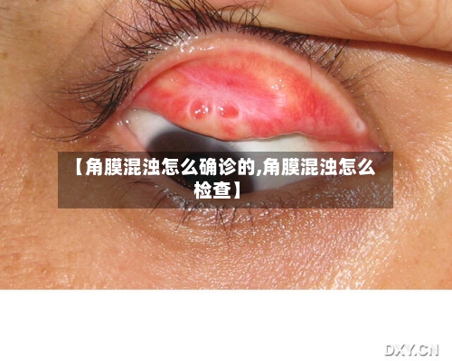 【角膜混浊怎么确诊的,角膜混浊怎么检查】