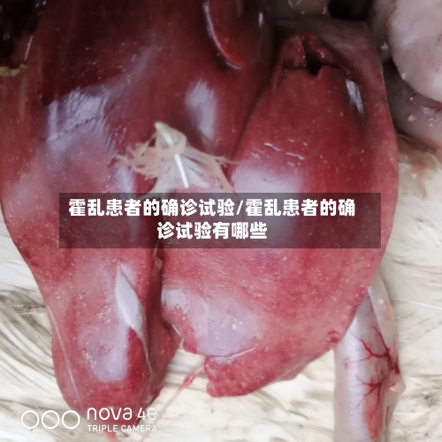 霍乱患者的确诊试验/霍乱患者的确诊试验有哪些