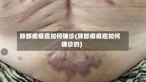 肺部瘢痕癌如何确诊(肺部瘢痕癌如何确诊的)