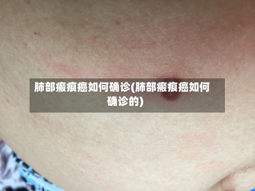 肺部瘢痕癌如何确诊(肺部瘢痕癌如何确诊的)