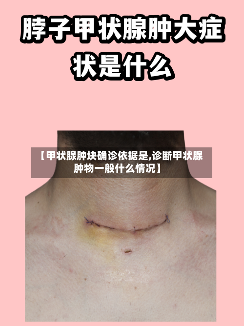 【甲状腺肿块确诊依据是,诊断甲状腺肿物一般什么情况】