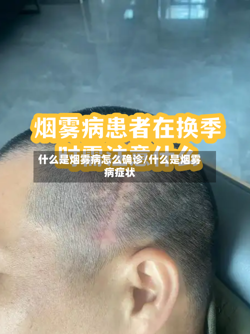什么是烟雾病怎么确诊/什么是烟雾病症状