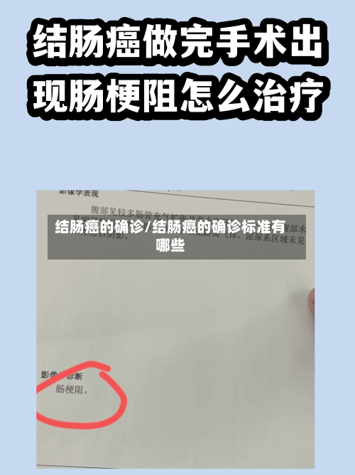 结肠癌的确诊/结肠癌的确诊标准有哪些