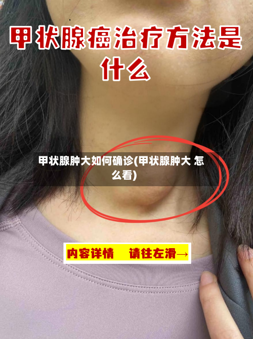 甲状腺肿大如何确诊(甲状腺肿大 怎么看)