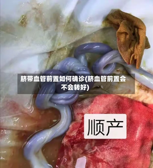 脐带血管前置如何确诊(脐血管前置会不会转好)