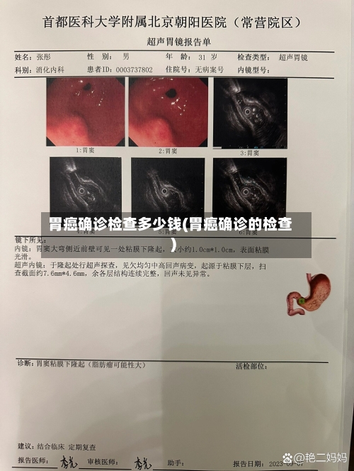胃癌确诊检查多少钱(胃癌确诊的检查)