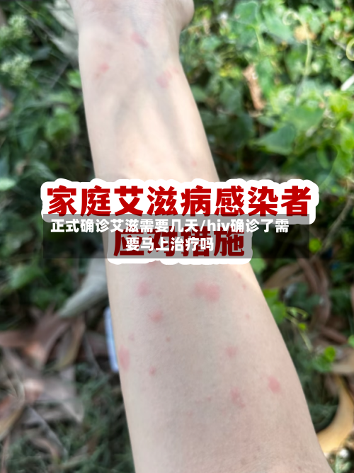 正式确诊艾滋需要几天/hiv确诊了需要马上治疗吗