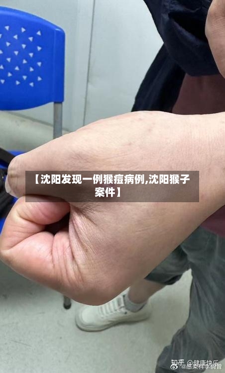【沈阳发现一例猴痘病例,沈阳猴子案件】