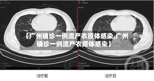 【广州确诊一例流产衣原体感染,广州确诊一例流产衣原体感染】