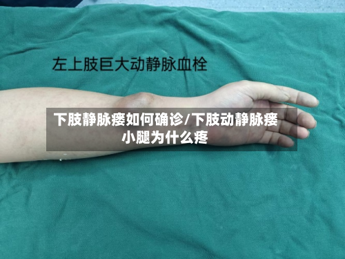下肢静脉瘘如何确诊/下肢动静脉瘘小腿为什么疼