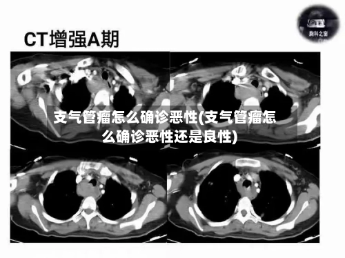 支气管瘤怎么确诊恶性(支气管瘤怎么确诊恶性还是良性)