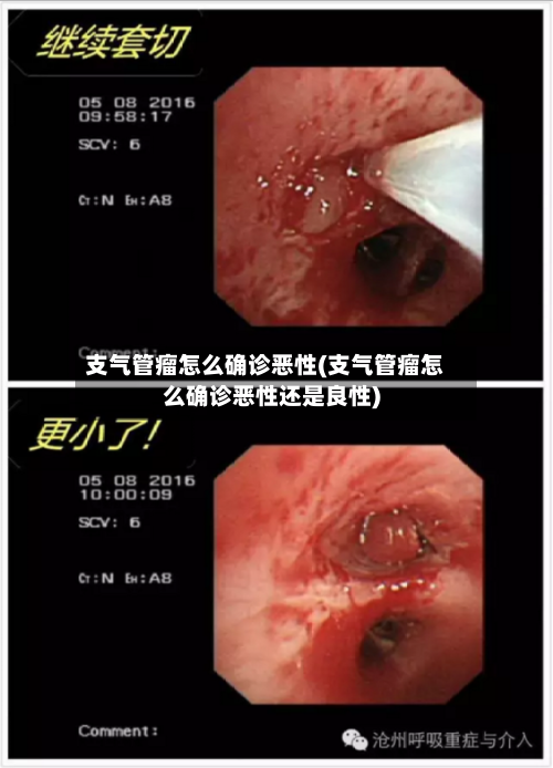 支气管瘤怎么确诊恶性(支气管瘤怎么确诊恶性还是良性)