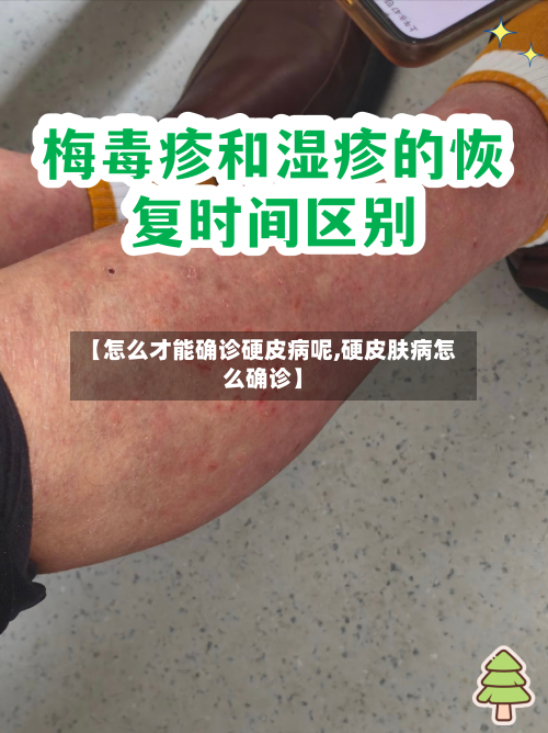 【怎么才能确诊硬皮病呢,硬皮肤病怎么确诊】