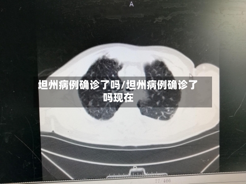 坦州病例确诊了吗/坦州病例确诊了吗现在