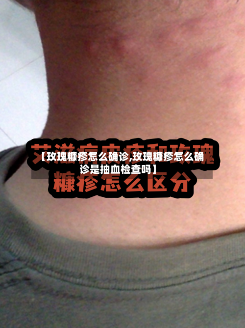 【玫瑰糠疹怎么确诊,玫瑰糠疹怎么确诊是抽血检查吗】
