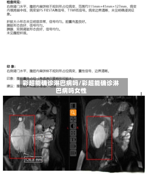彩超能确诊淋巴病吗/彩超能确诊淋巴病吗女性