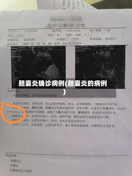 胆囊炎确诊病例(胆囊炎的病例)