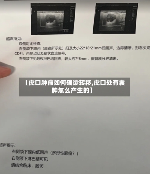 【虎口肿瘤如何确诊转移,虎口处有囊肿怎么产生的】