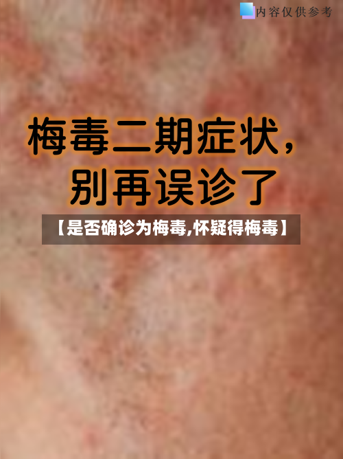 【是否确诊为梅毒,怀疑得梅毒】