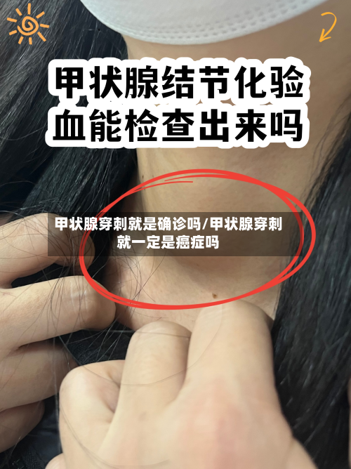 甲状腺穿刺就是确诊吗/甲状腺穿刺就一定是癌症吗