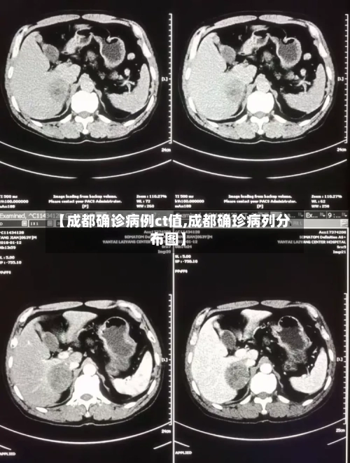 【成都确诊病例ct值,成都确珍病列分布图】