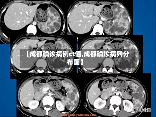 【成都确诊病例ct值,成都确珍病列分布图】