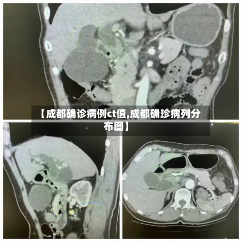 【成都确诊病例ct值,成都确珍病列分布图】