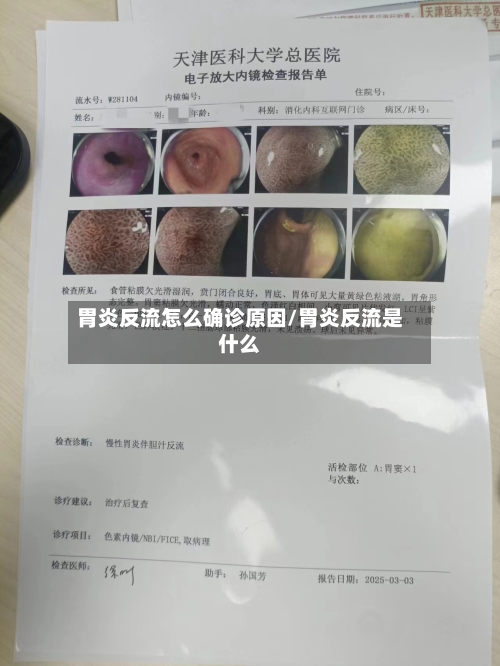 胃炎反流怎么确诊原因/胃炎反流是什么