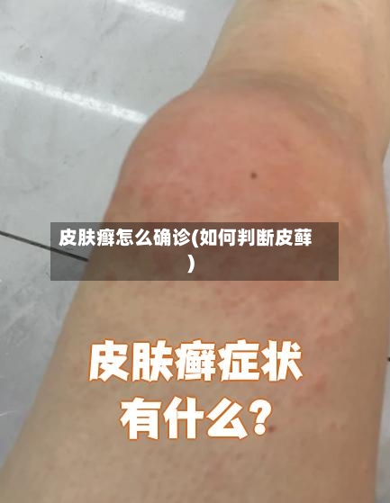 皮肤癣怎么确诊(如何判断皮藓)