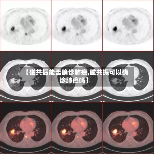 【磁共振能否确诊肺癌,磁共振可以确诊肺癌吗】