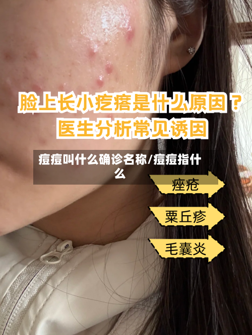 痘痘叫什么确诊名称/痘痘指什么