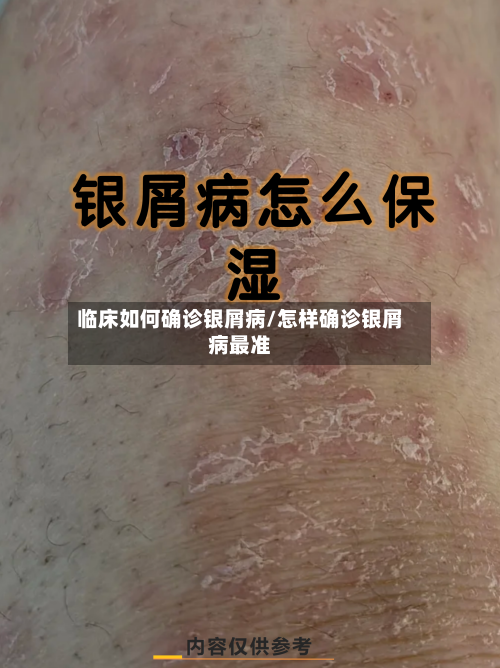 临床如何确诊银屑病/怎样确诊银屑病最准