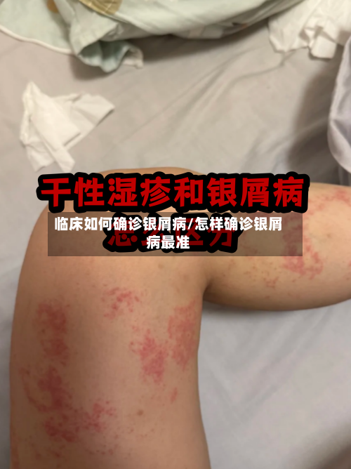 临床如何确诊银屑病/怎样确诊银屑病最准