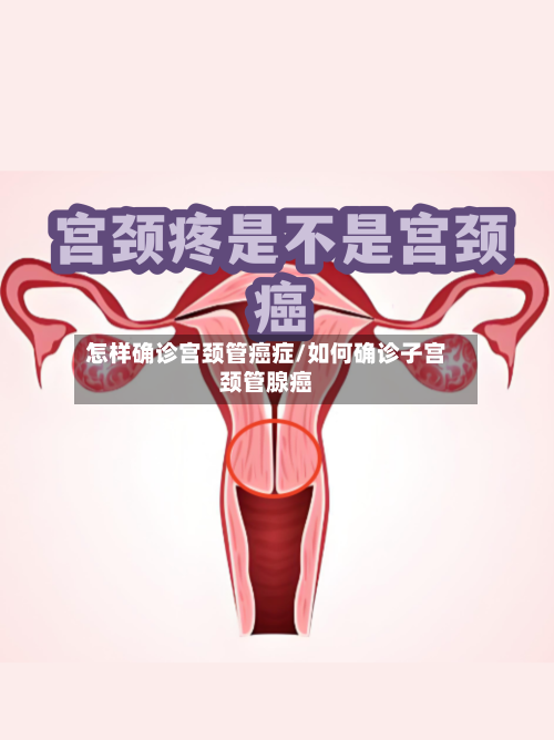 怎样确诊宫颈管癌症/如何确诊子宫颈管腺癌