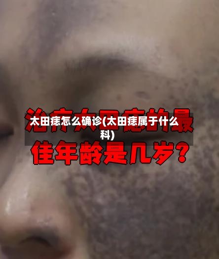 太田痣怎么确诊(太田痣属于什么科)
