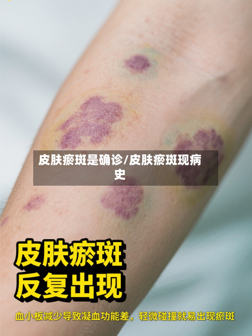皮肤瘀斑是确诊/皮肤瘀斑现病史