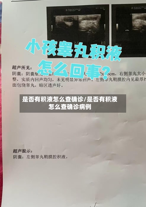 是否有积液怎么查确诊/是否有积液怎么查确诊病例