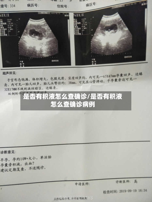 是否有积液怎么查确诊/是否有积液怎么查确诊病例
