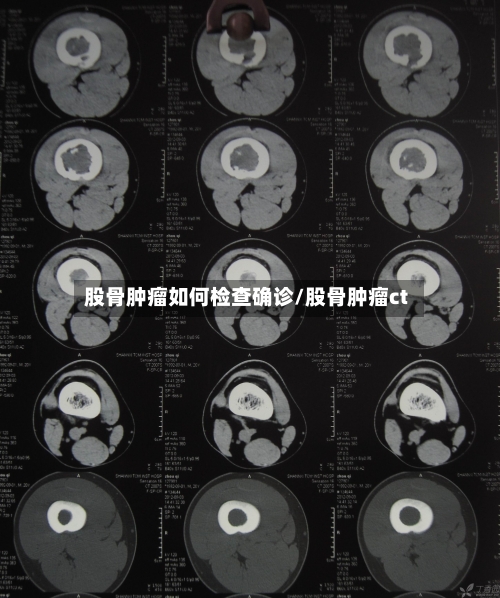 股骨肿瘤如何检查确诊/股骨肿瘤ct