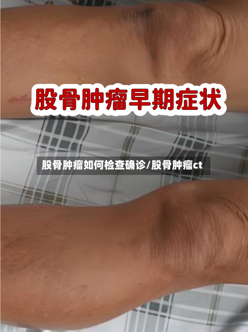 股骨肿瘤如何检查确诊/股骨肿瘤ct