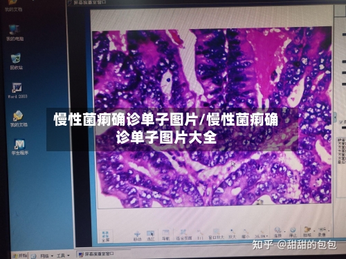 慢性菌痢确诊单子图片/慢性菌痢确诊单子图片大全