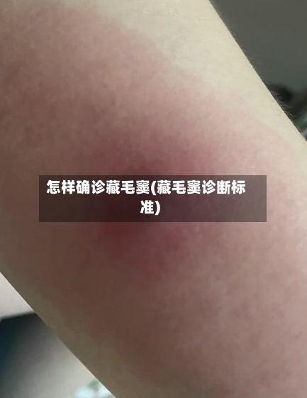 怎样确诊藏毛窦(藏毛窦诊断标准)