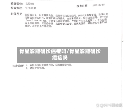 骨显影能确诊癌症吗/骨显影能确诊癌症吗