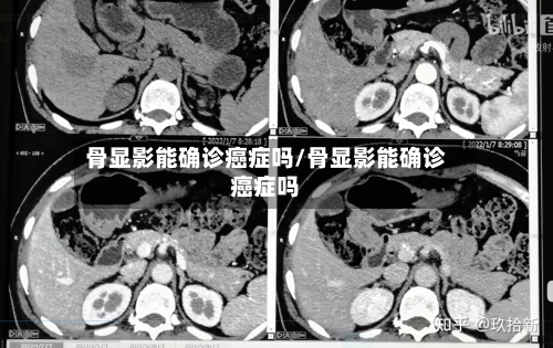 骨显影能确诊癌症吗/骨显影能确诊癌症吗