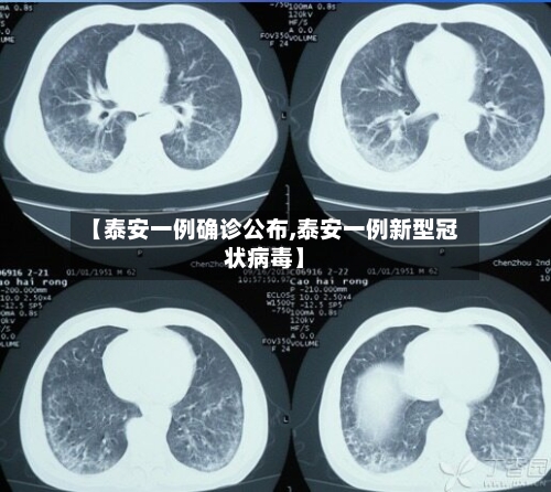 【泰安一例确诊公布,泰安一例新型冠状病毒】