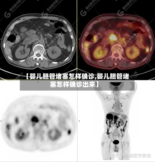 【婴儿胆管堵塞怎样确诊,婴儿胆管堵塞怎样确诊出来】