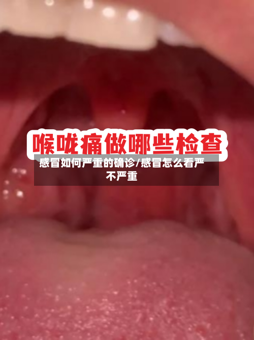 感冒如何严重的确诊/感冒怎么看严不严重