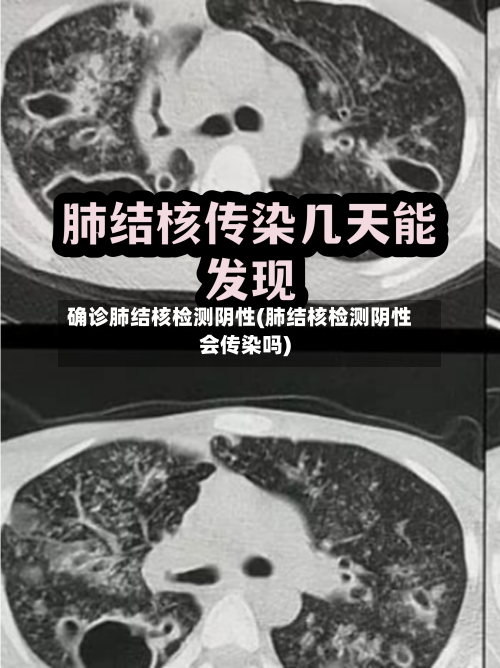 确诊肺结核检测阴性(肺结核检测阴性会传染吗)