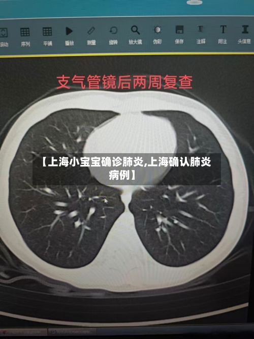 【上海小宝宝确诊肺炎,上海确认肺炎病例】
