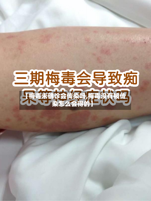 【梅毒未确诊会传染吗,梅毒没有被传染怎么会得的】
